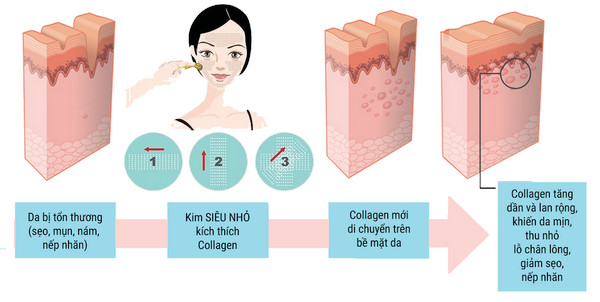 Phương pháp lăn kim, phi kim là gì?