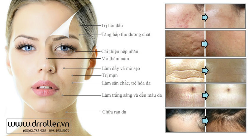 Ưu điểm của phương pháp lăn kim, phi kim